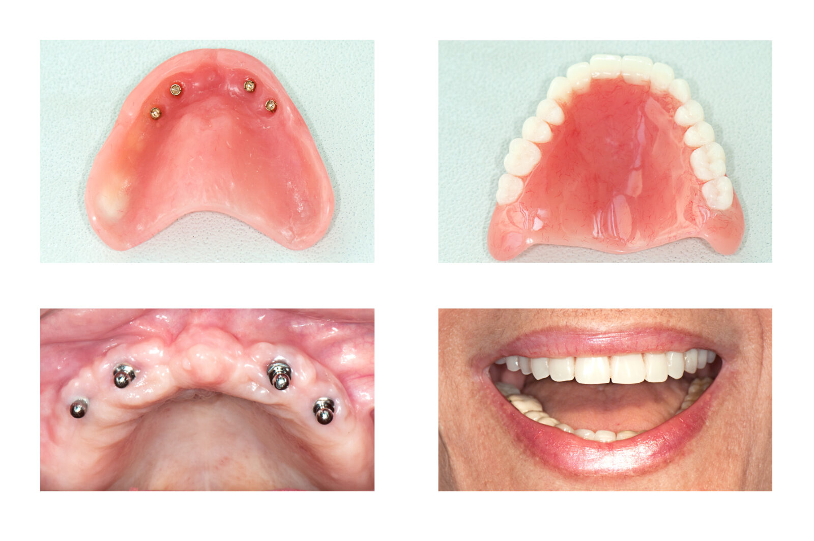 Implant Retained Dentures Hq Dental Leeds Uk 