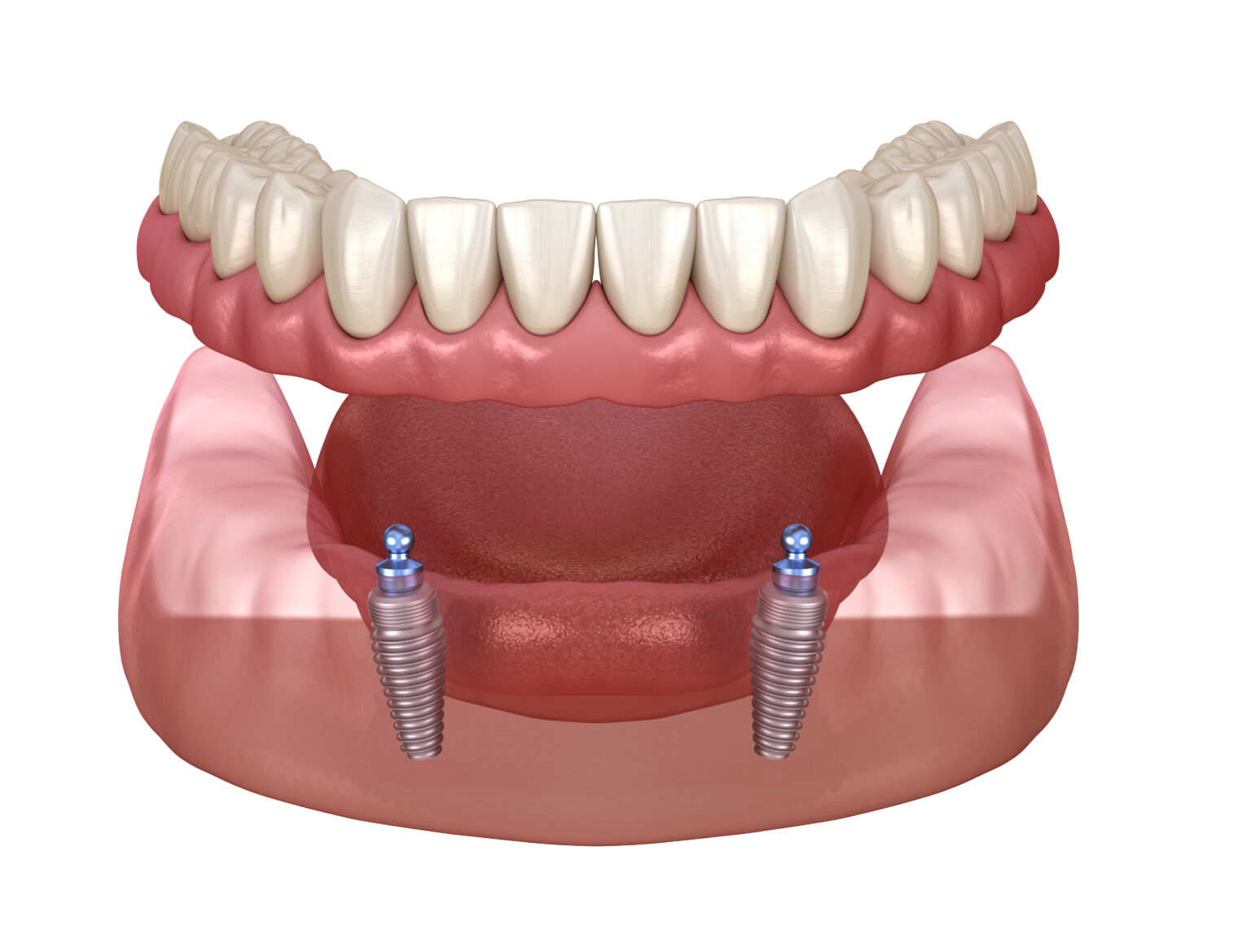Implants For Dentures 1536x1169 