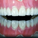 denture_independent_1