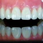 denture_premiere_1